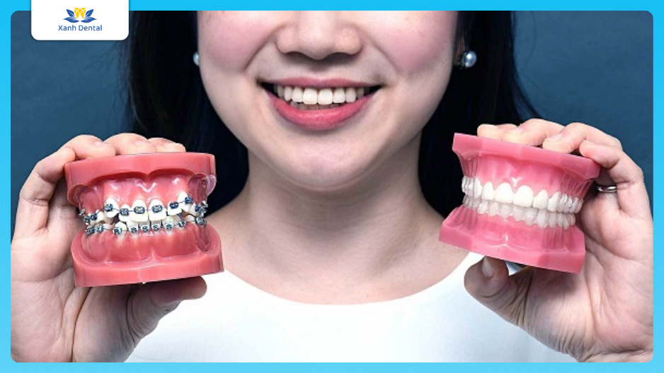 Niềng răng Nhổn giá bao nhiêu? Nên chọn mắc cài hay Invisalign?